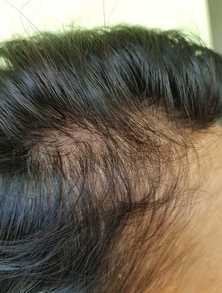 Frontale Fibroserende Alopecia behandeling voor